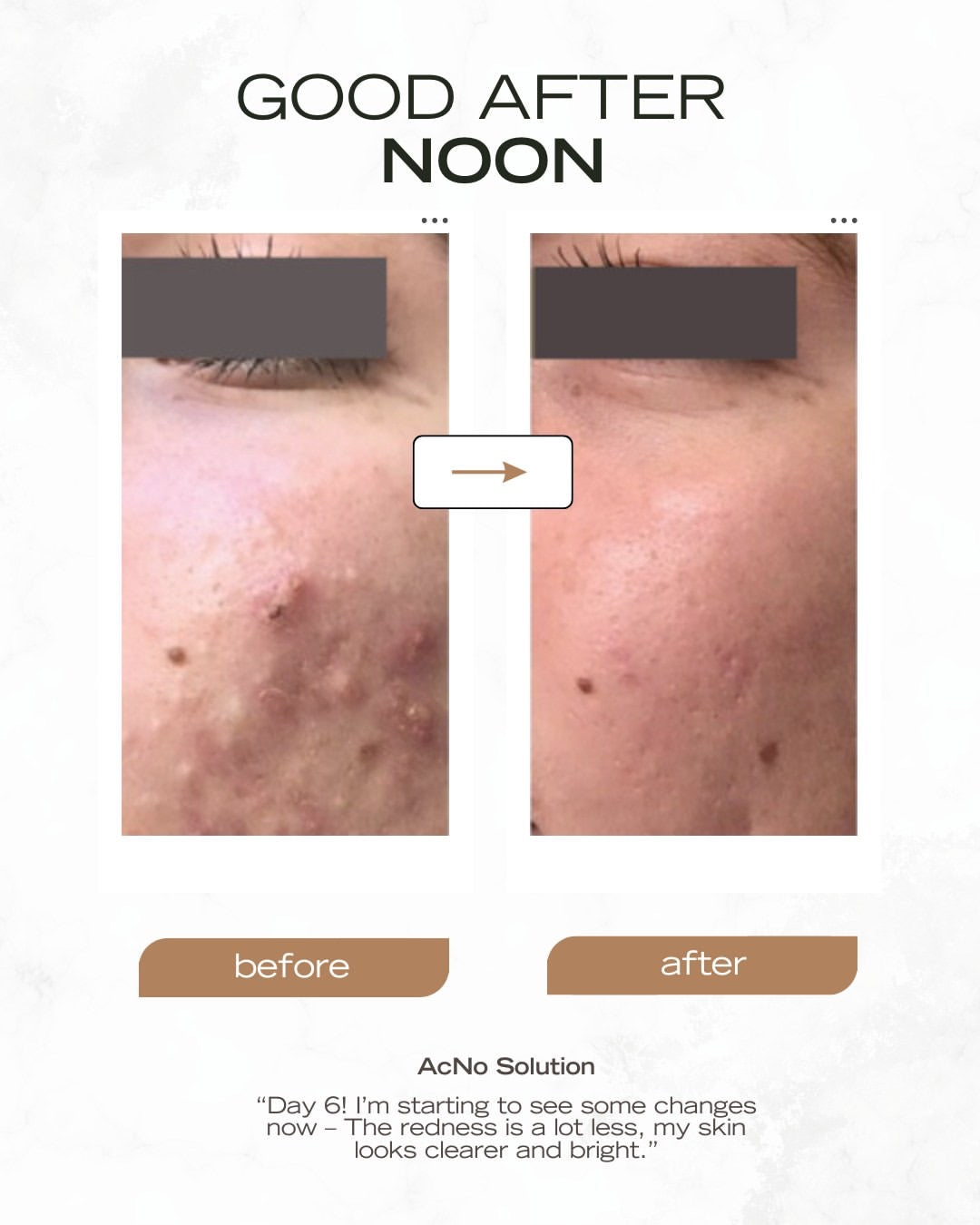 Noon Aesthetics AcNo Solution Serum