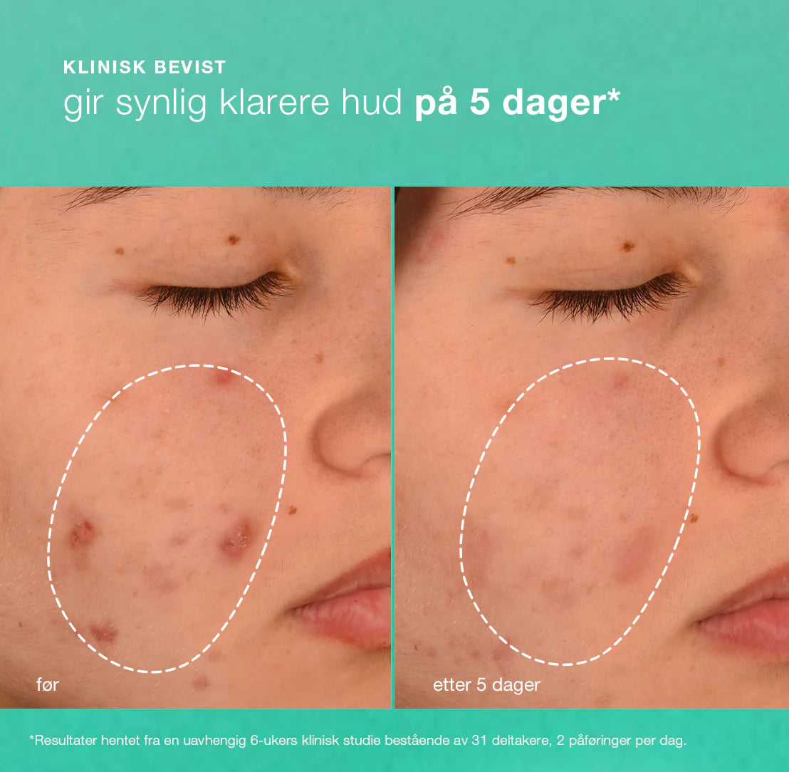 Breakout Biotic Moisturizer 50ml Ansiktsmaske